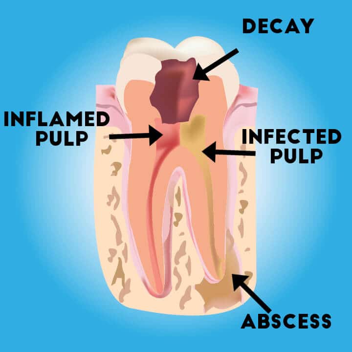  Root Canal Pain Is A Thing Of The Past NSB Endodontics